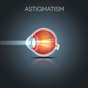 Chart Showing How Astigmatism Affects an Eye