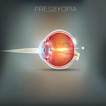 Chart Showing How Presbyopia Affects an Eye